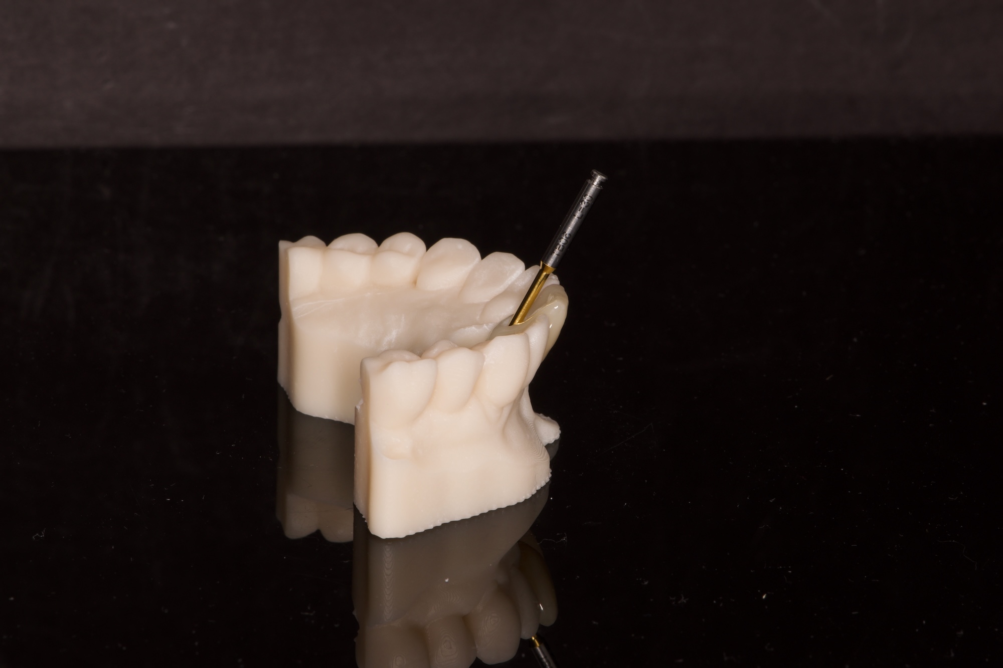 Zirconia Implant Crown on ASC Customised Abutment